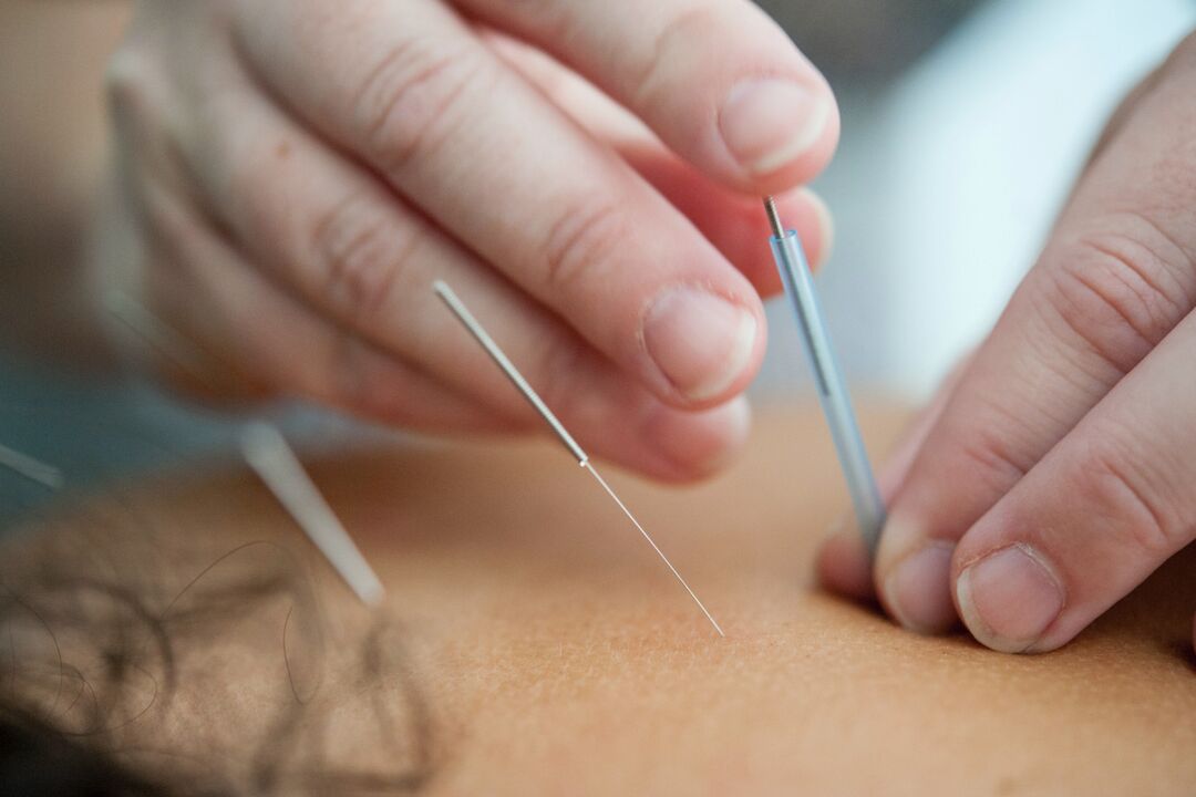 Acupuncture is an ineffective means of quitting smoking