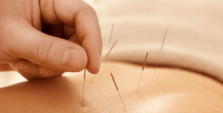 smoking acupuncture